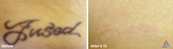 Before and after tattoo removal